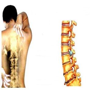 Osteokondroz aşamaları