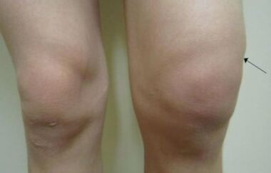 Diz ekleminin artrozunun klinik belirtileri
