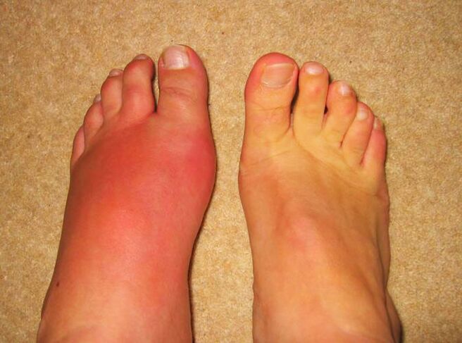 gut nedeniyle bacak eklemlerinde ağrı