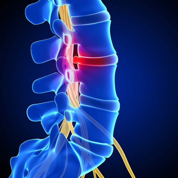 Lomber omurganın osteokondrozundan kaynaklanan intervertebral diskin spinal kanala çıkıntısı